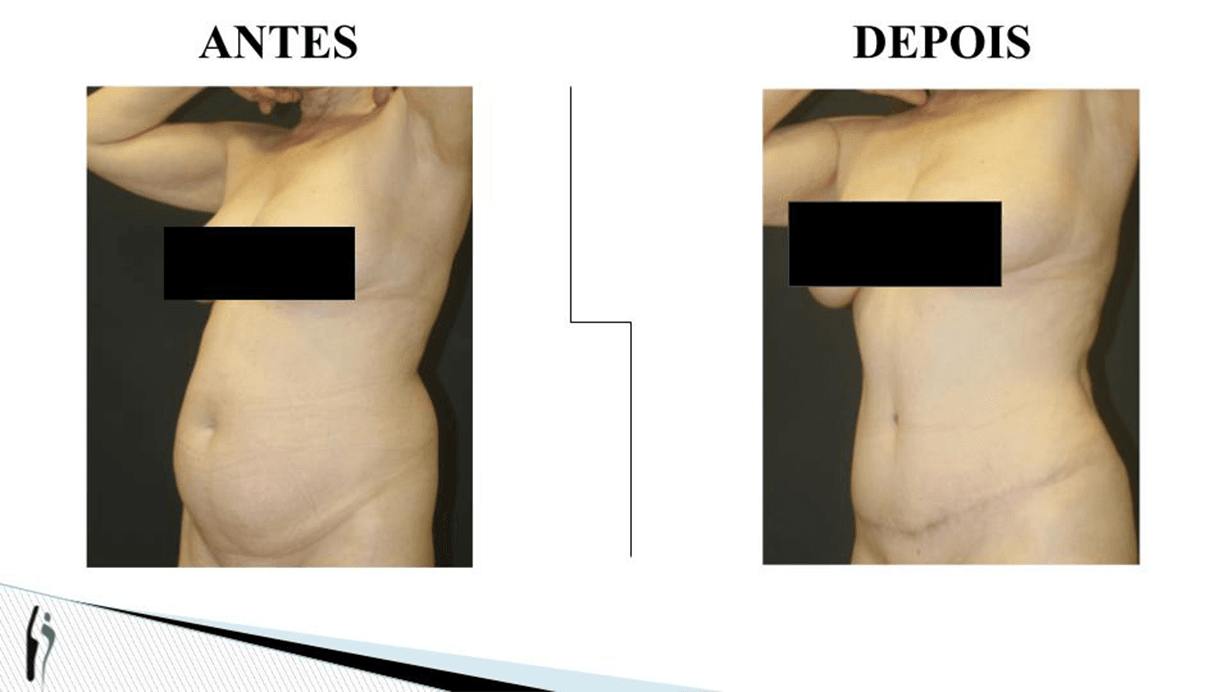 ABDOMINOPLASTIA.pptx
