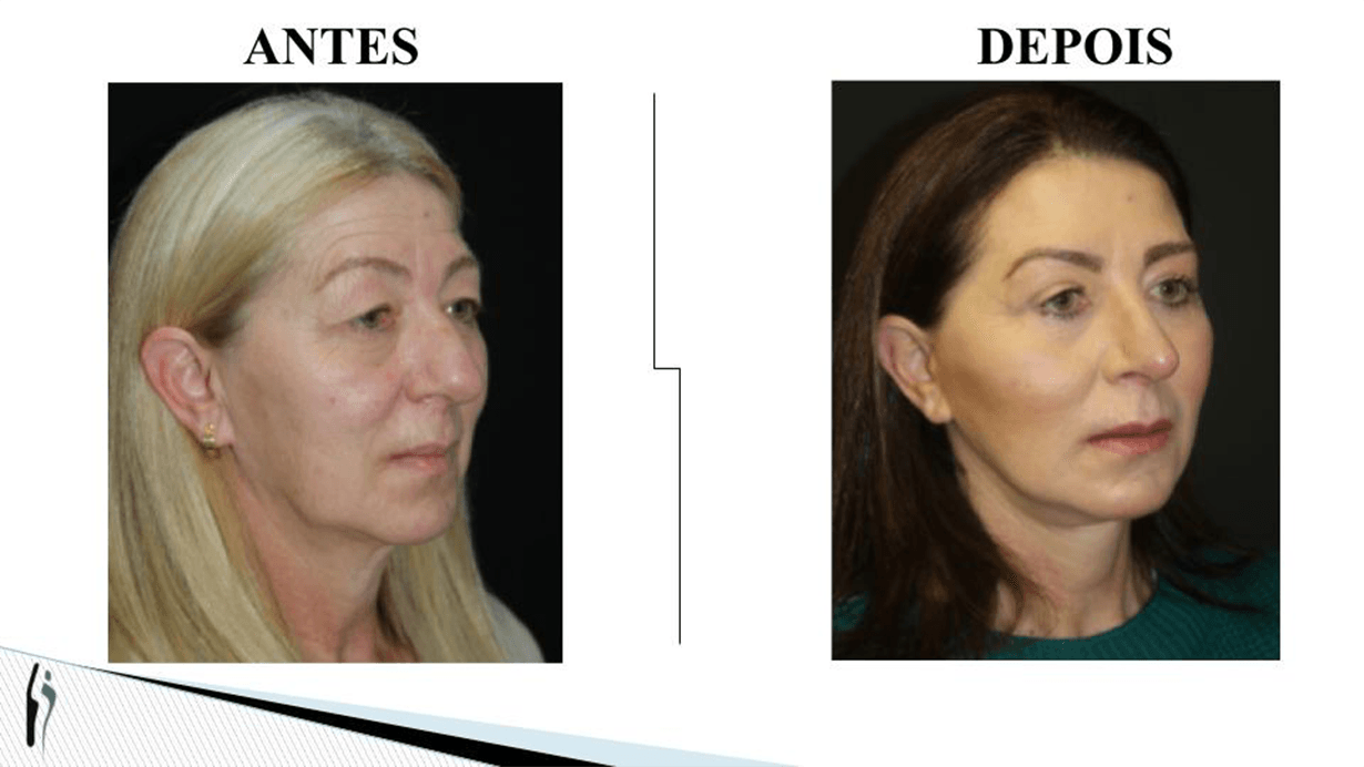 LIFTING FACIAL.pptx (1)