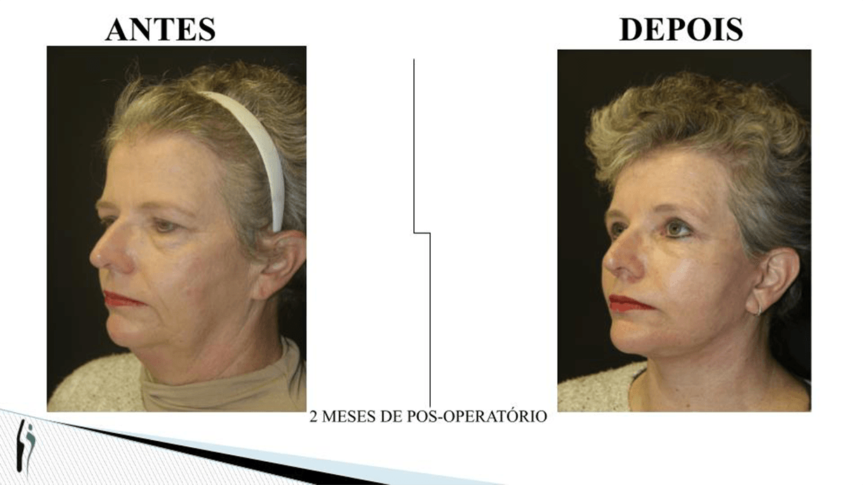 LIFTING FACIAL.pptx (4)