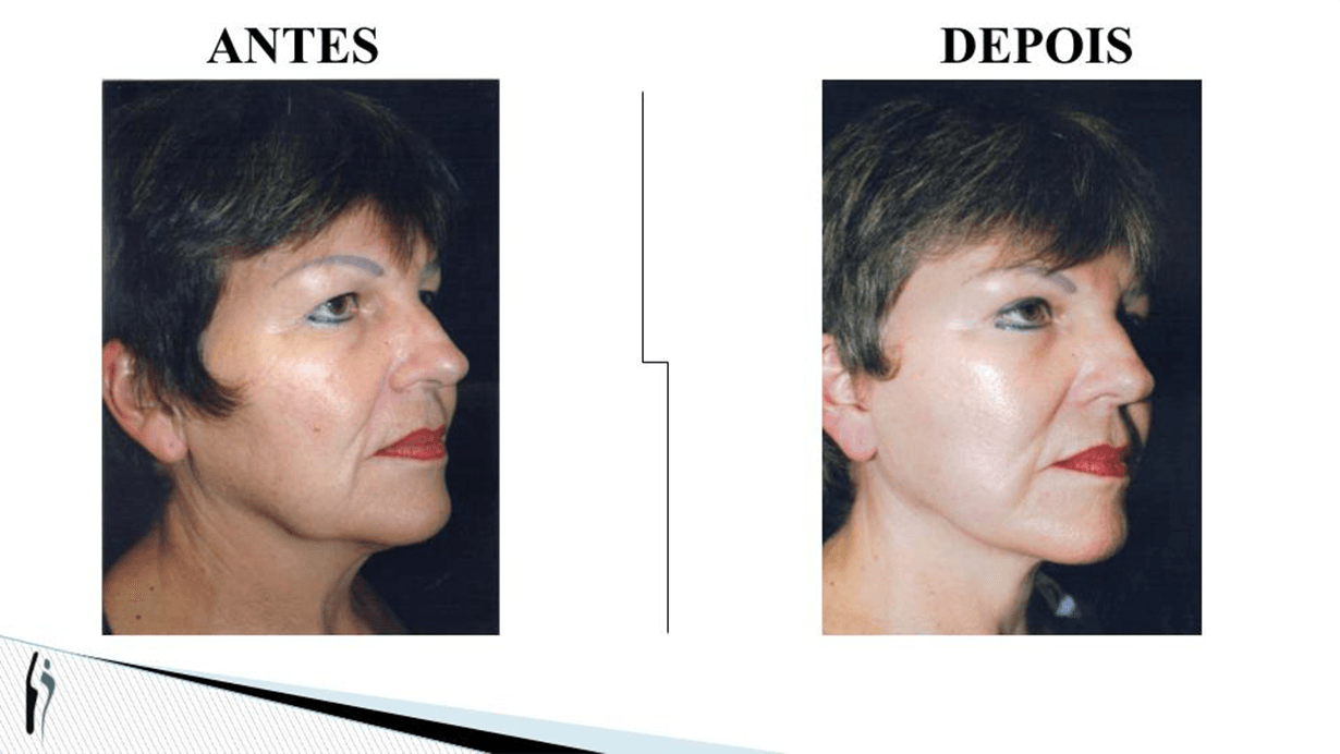 LIFTING FACIAL.pptx